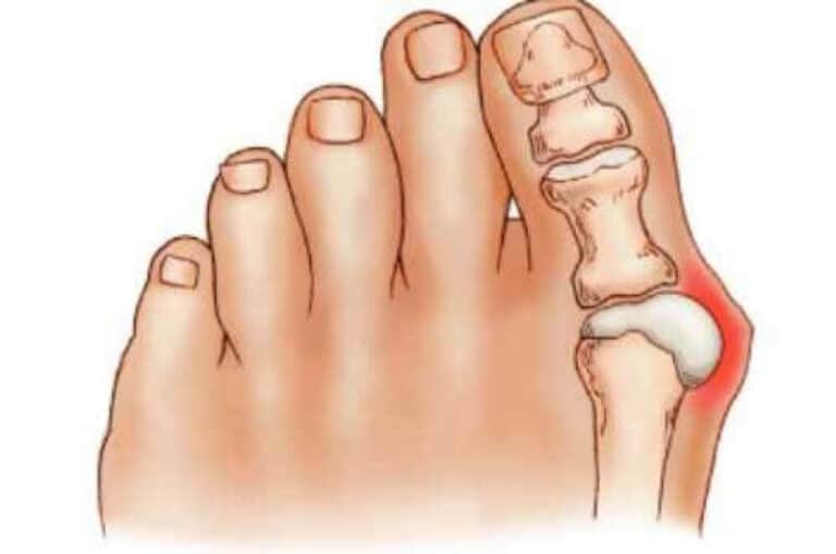 Pain In The Big Toe Most Common Causes In 2024 ️