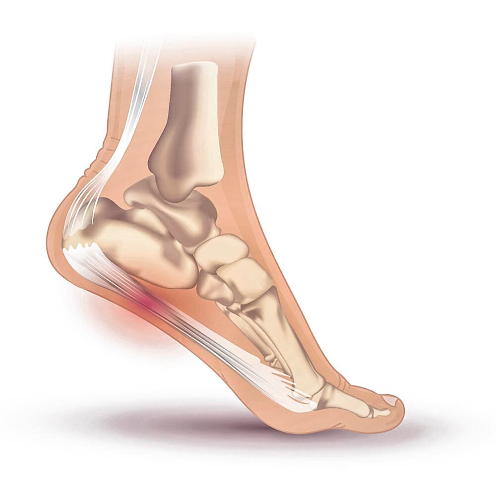 Fasciitis Plantar Stretches and Exercises【2024