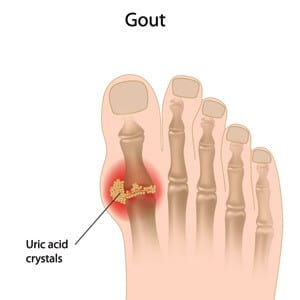 Gout Pain in the big toe