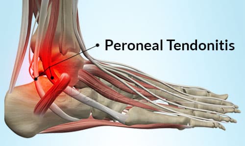 Tendonitis Peroneal Pain
